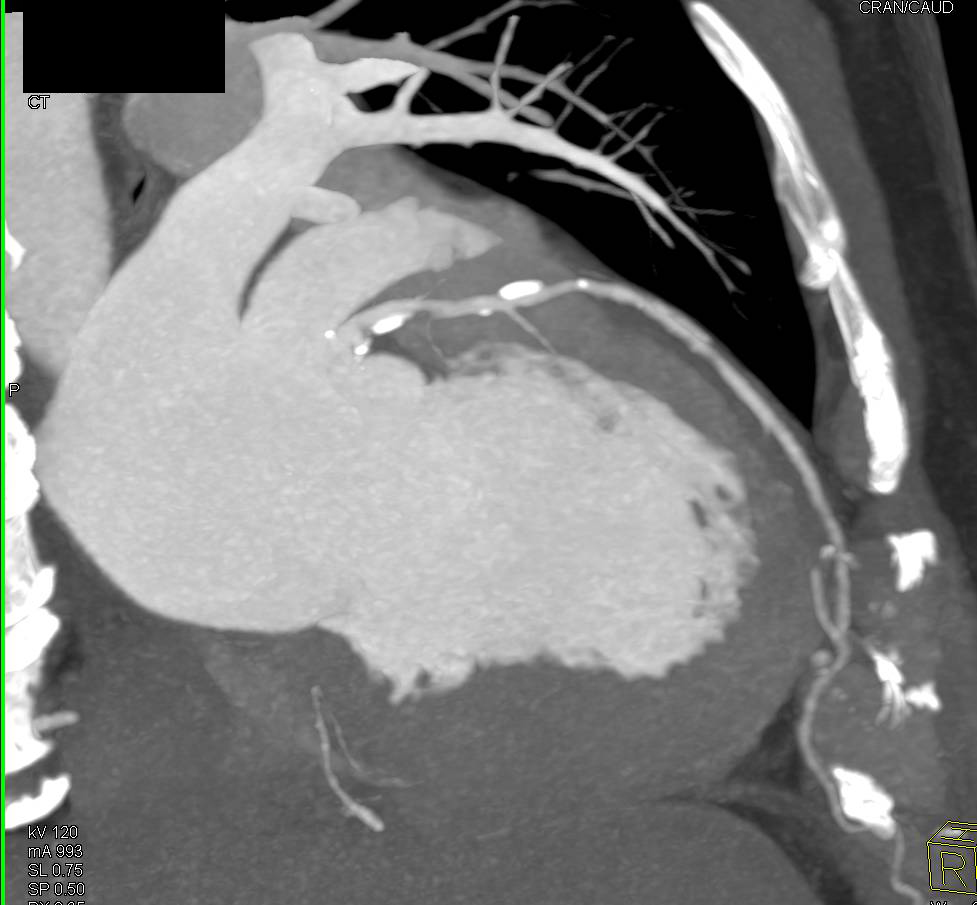 CCTA: Left Anterior Descending Artery (LAD) Plaque Without Stenosis - CTisus CT Scan