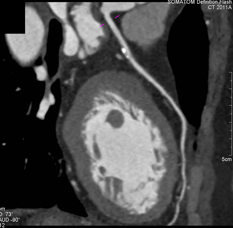 CCTA: Left Anterior Descending Artery (LAD) Plaque - CTisus CT Scan