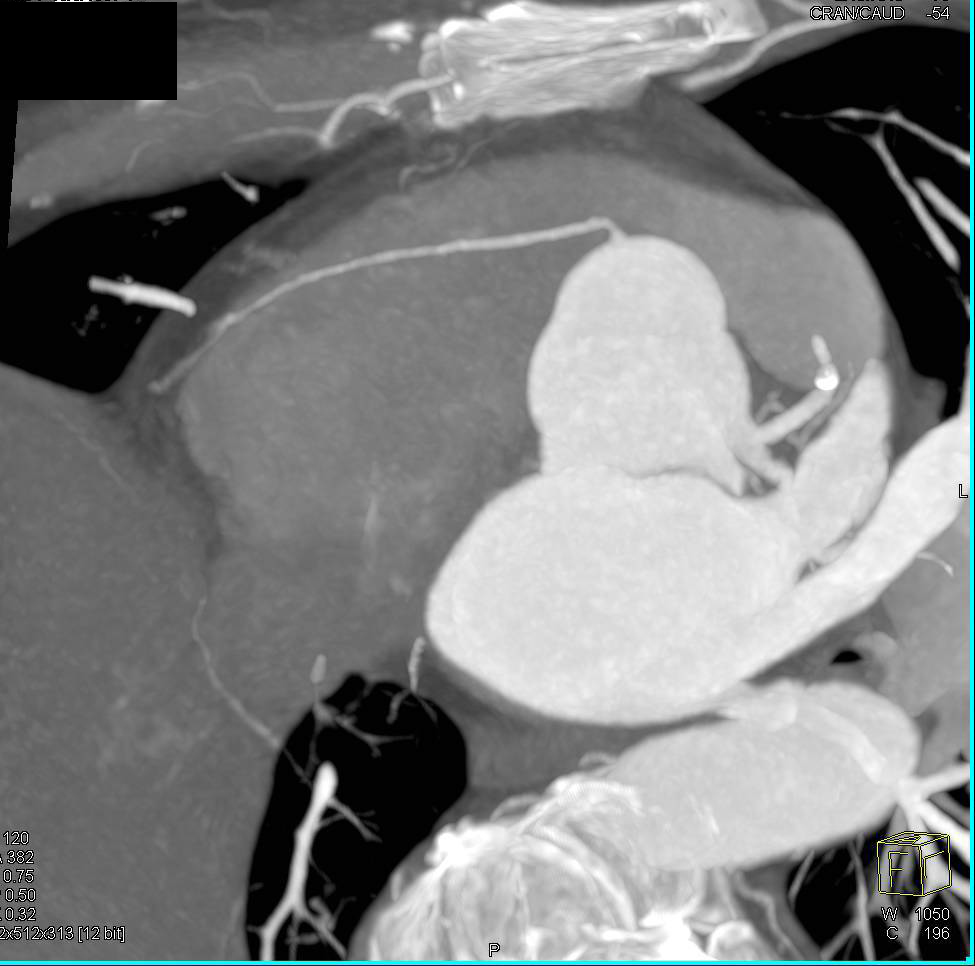 CCTA: Calcified Plaque Left Anterior Descending Coronary Artery (LAD) - CTisus CT Scan