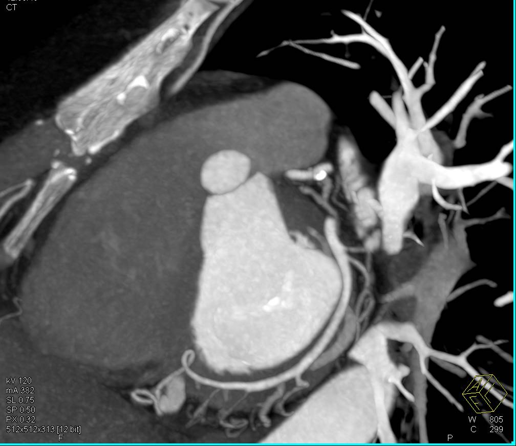 CCTA: Minimal Plaque in 3D Mode - CTisus CT Scan