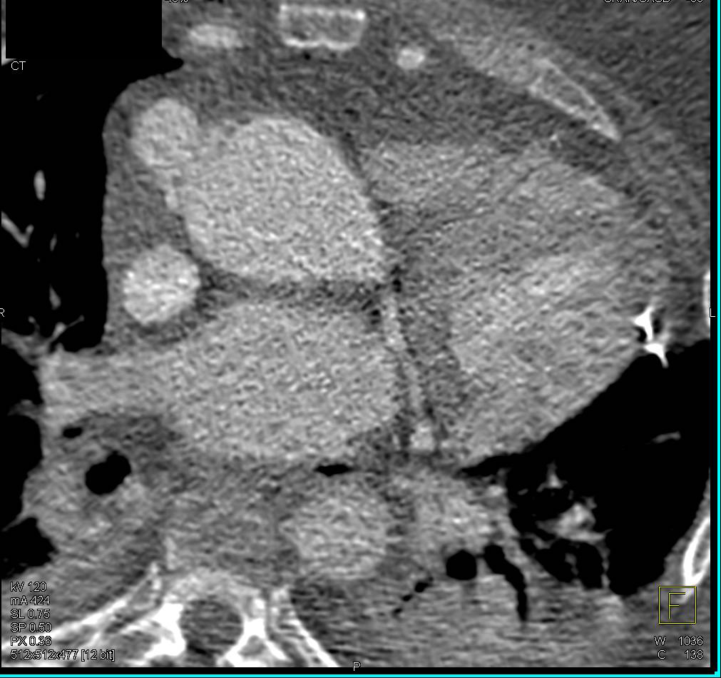 Vascular Canal Created for Bypass - CTisus CT Scan