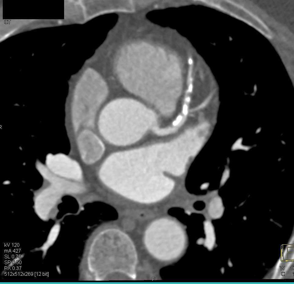 CCTA: Extensive Calcified Left Anterior Descending Coronary Artery (LAD) Plaque - CTisus CT Scan