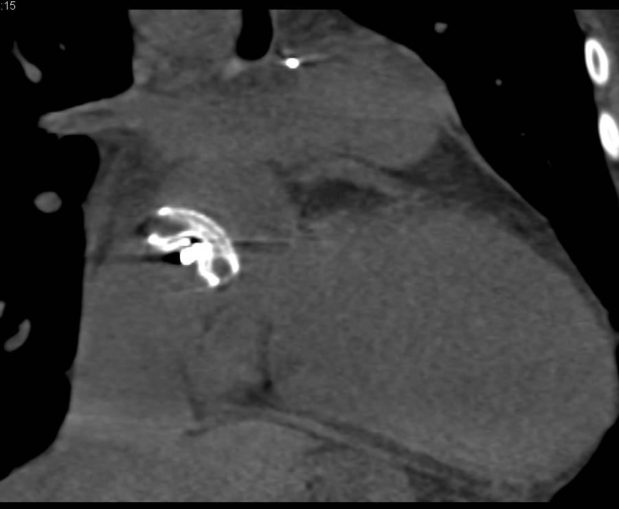 Normal AV Replacement - CTisus CT Scan