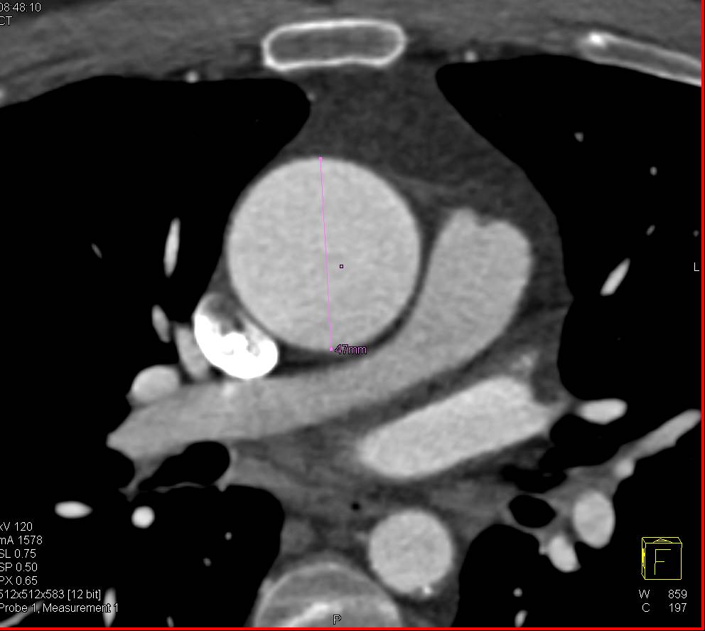 Bicuspid Aortic Valve with Calcification and Dilated Aortic Root - CTisus CT Scan