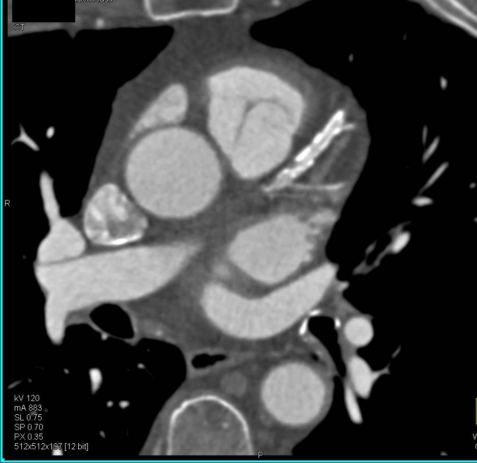 CCTA: Multivessel Disease - CTisus CT Scan