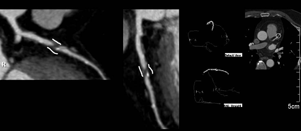 CCTA: Critical Left Anterior Descending Coronary Artery (LAD) Stenosis with Rcadia Software - CTisus CT Scan