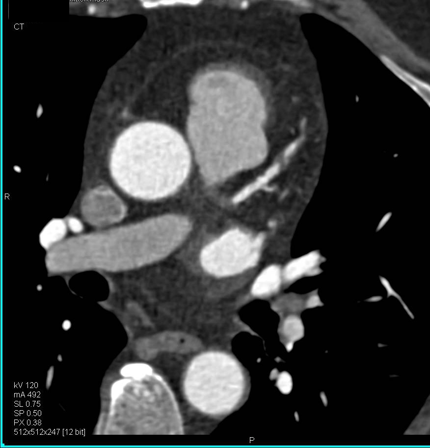 CCTA: Critical Left Anterior Descending Coronary Artery (LAD) Stenosis - CTisus CT Scan