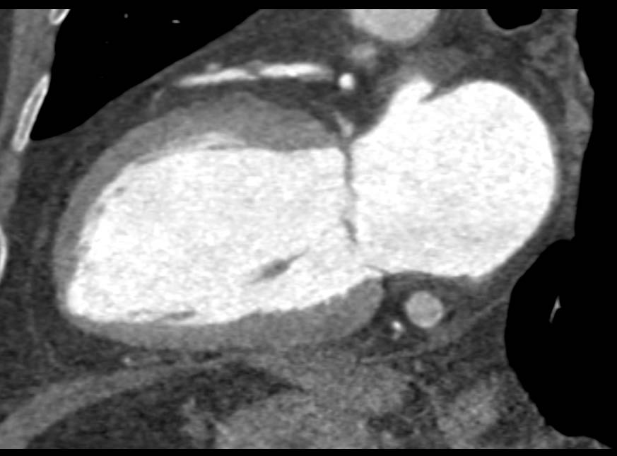 CCTA: Critical Left Anterior Descending Coronary Artery (LAD) Stenosis with Near Occlusion - CTisus CT Scan