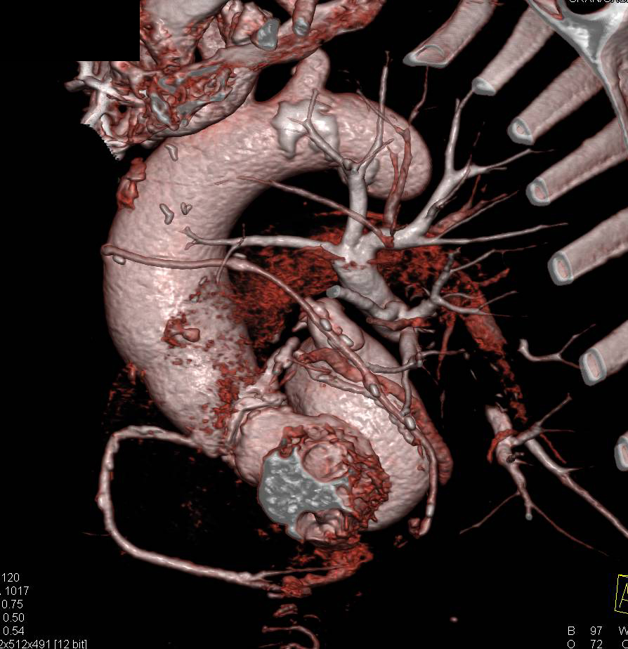 3D Mapping of Coronary Artery Bypass Graft (CABG) - CTisus CT Scan