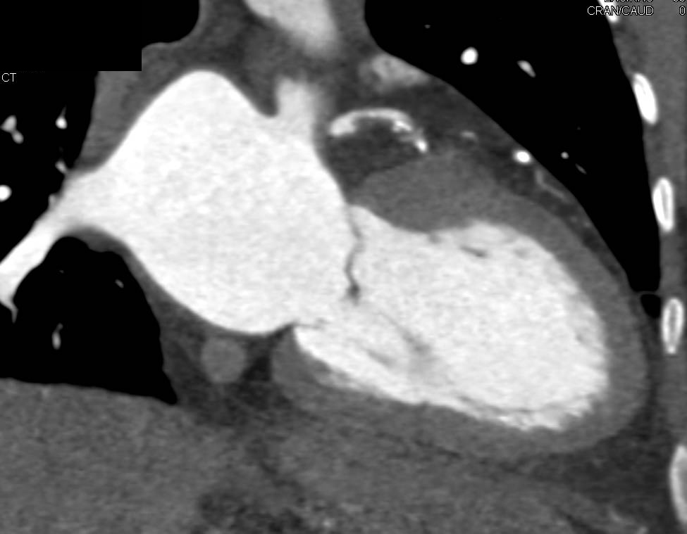 CCTA: Left Anterior Descending Coronary Artery (LAD) Plaque with Greater Than 50% Stenosis - CTisus CT Scan