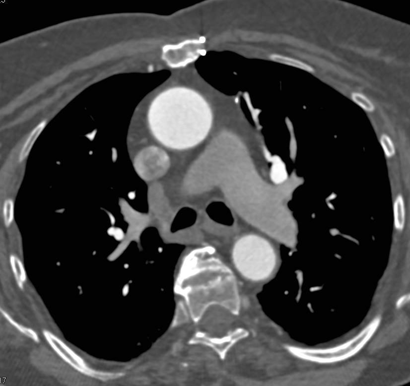 3D Map of Coronary Artery Bypass Graft (CABG) - CTisus CT Scan