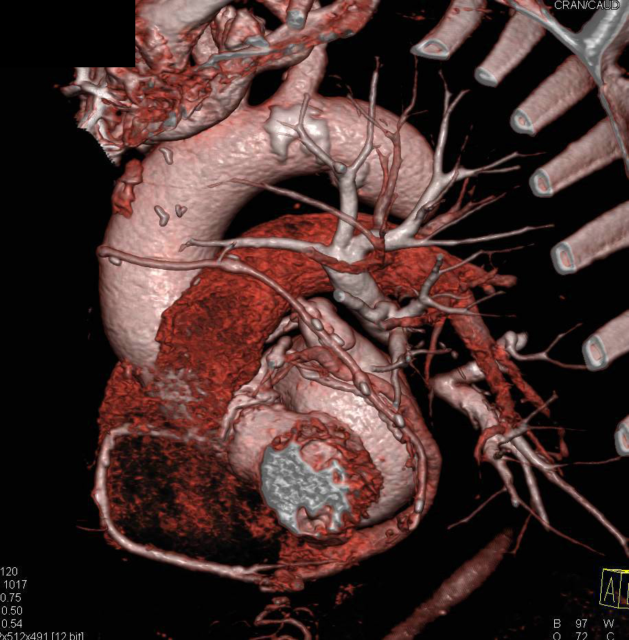 Multiple Bypass Grafts off Aorta - CTisus CT Scan