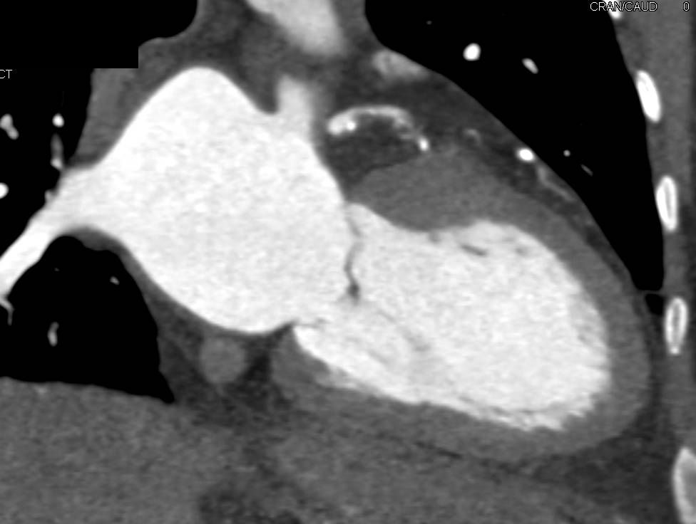 CCTA with Left Anterior Descending Coronary Artery (LAD) Disease - CTisus CT Scan