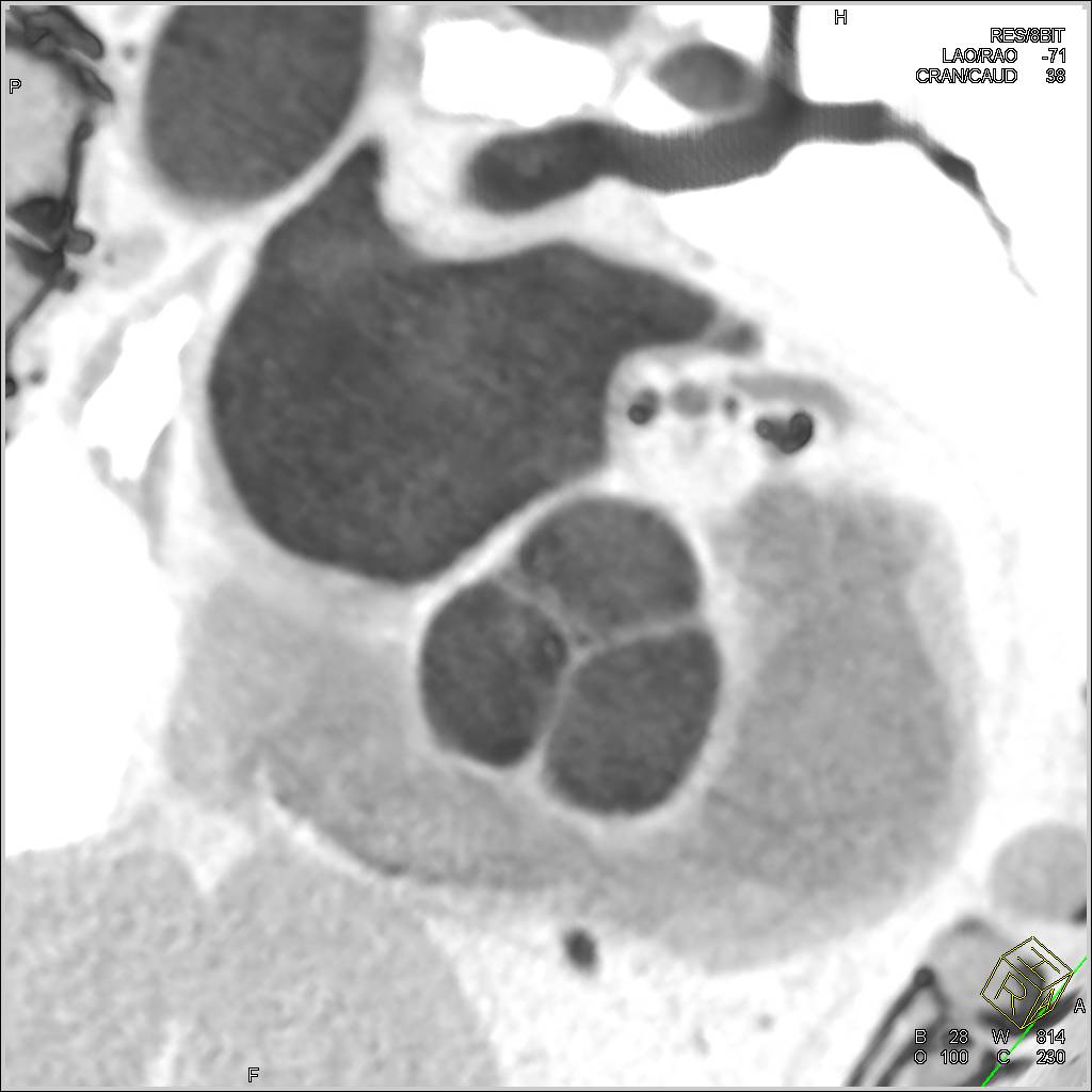 Normal Aortic Valve - CTisus CT Scan