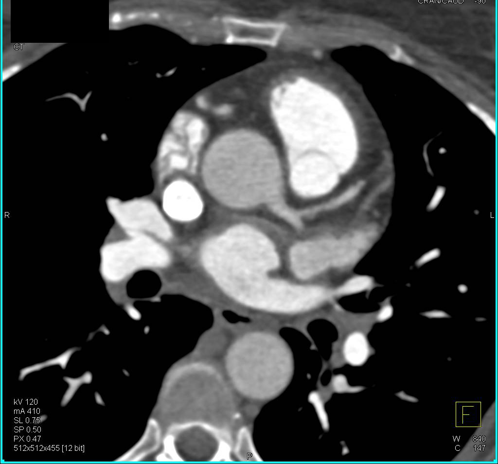 Poorly Timed Coronary Artery CTA - CTisus CT Scan