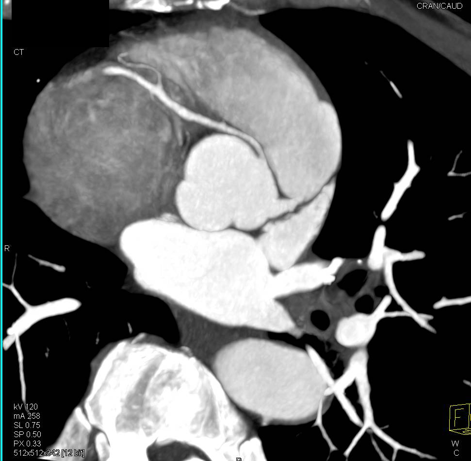 CCTA: Right Coronary Artery Arises off the Left Cusp in Malignant Configuration - CTisus CT Scan