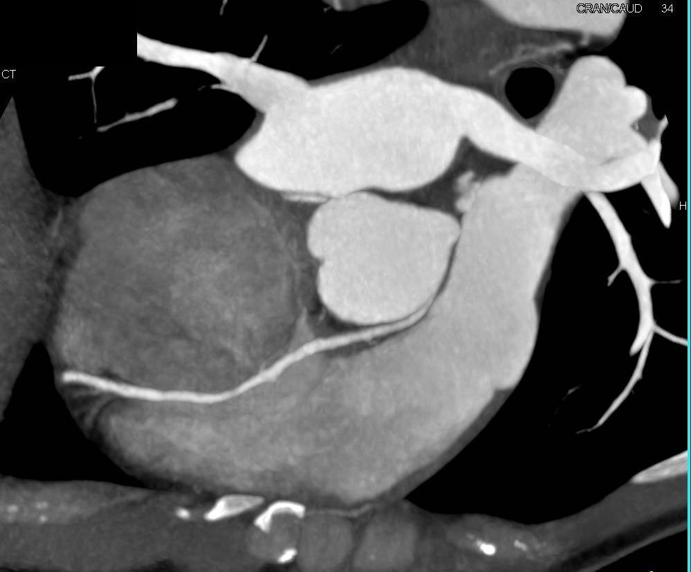 CCTA: Right Coronary Artery Arises off the Left Cusp in Malignant Configuration - CTisus CT Scan