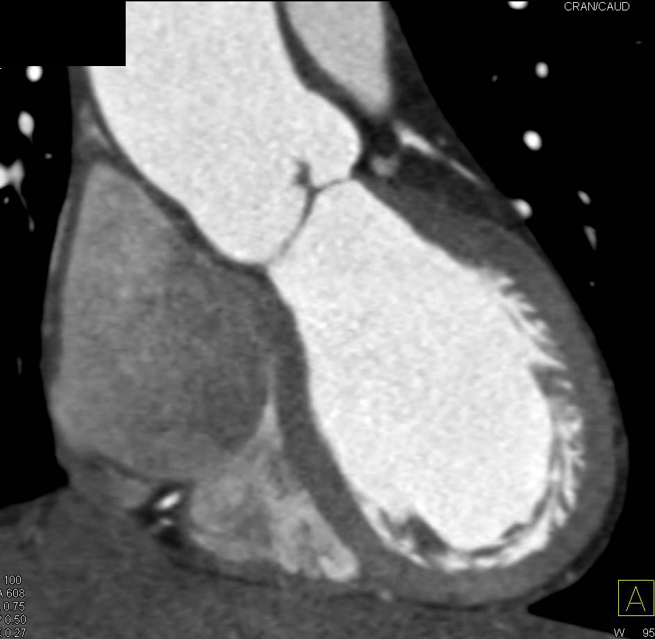 Focal Ulceration Aortic Arch - CTisus CT Scan