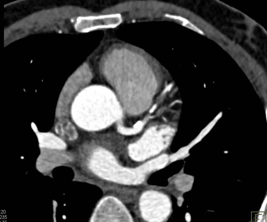 CCTA: Critical Left Anterior Descending Coronary Artery (LAD) Stenosis - CTisus CT Scan