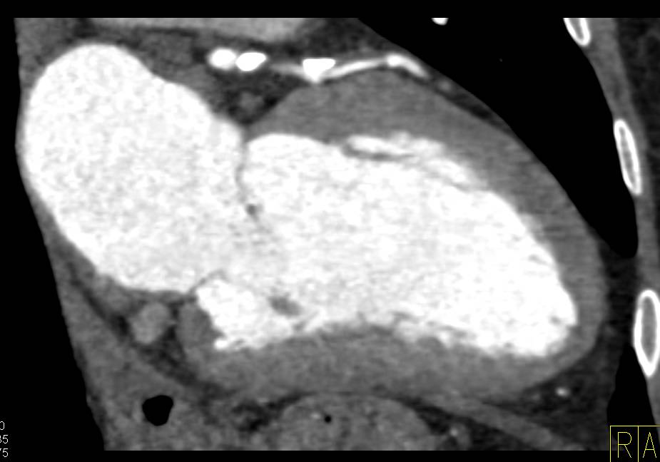 CCTA: Critical Left Anterior Descending Coronary Artery (LAD) Stenosis with Mixed Plaque - CTisus CT Scan