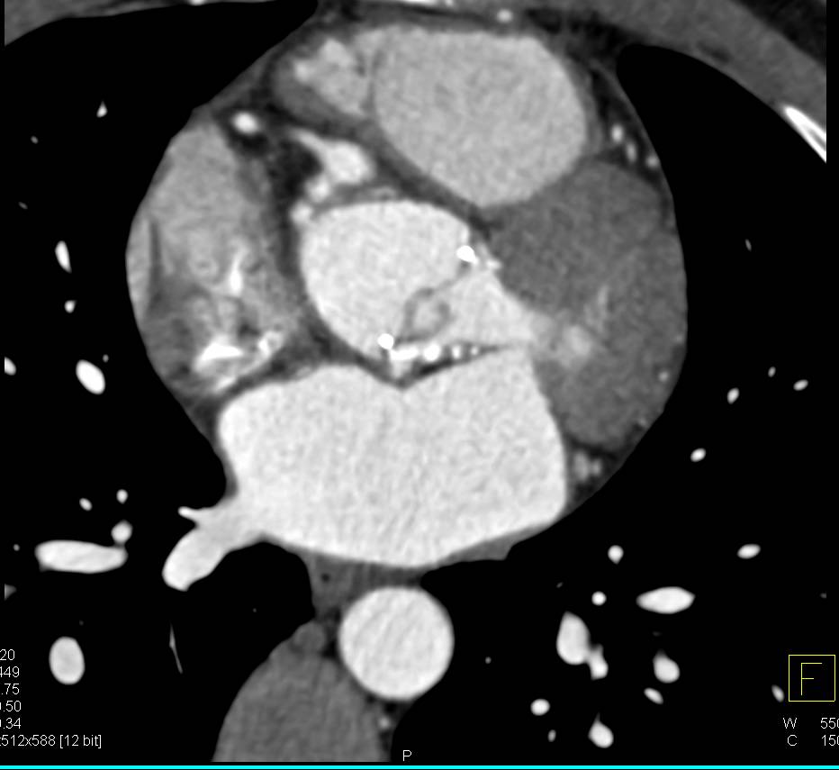 Aortic Valve Replacement (AVR) and Arch Dissection - CTisus CT Scan