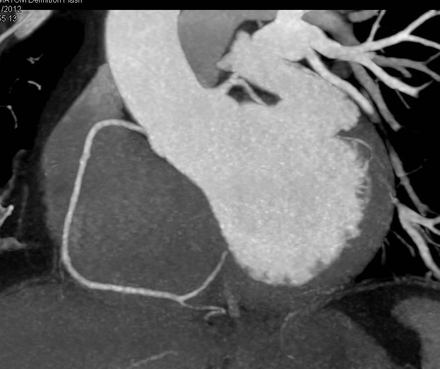 CCTA: Normal Right Coronary Artery (RCA) - CTisus CT Scan