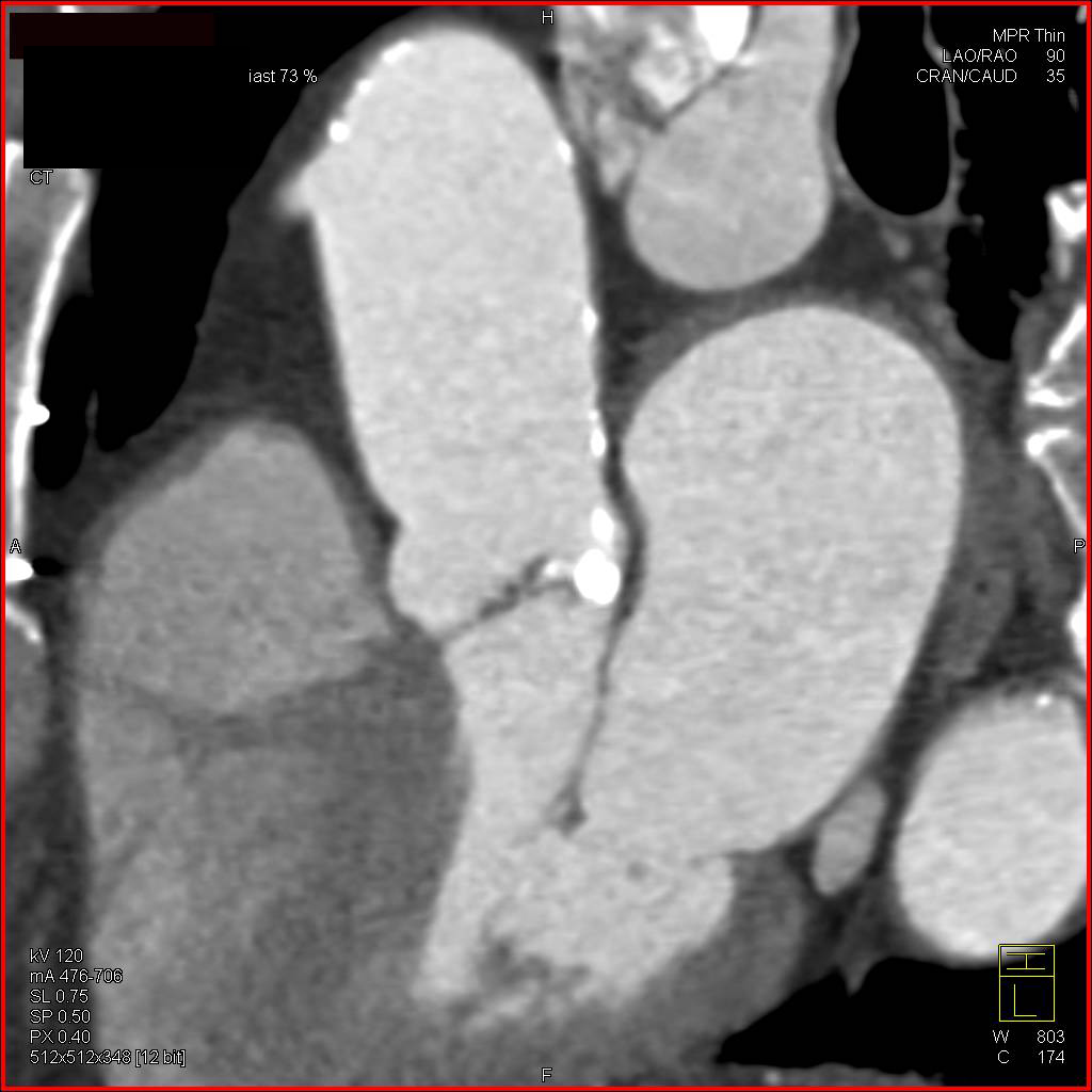 Aortic Valve Stenosis with Calcified Valve Leaflets and Coronary Artery Bypass Grafts (CABGs) - CTisus CT Scan