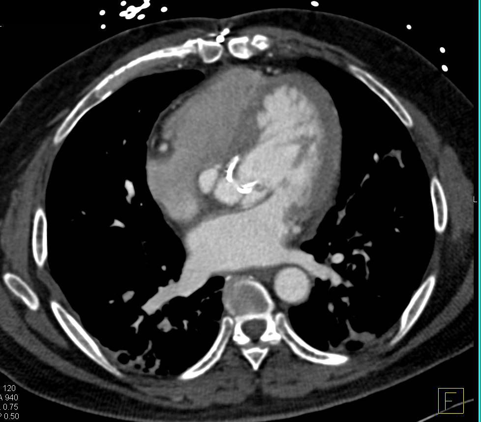 Pseudoaneurysms at Zone Near Aortic Valve Replacement (AVR) - CTisus CT Scan