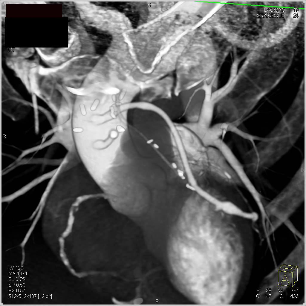 CCTA: Coronary Artery Bypass Graft (CABG) with one of the Venous Grafts Occluded - CTisus CT Scan