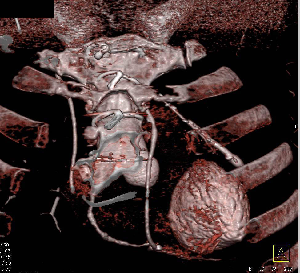 CCTA: Native Left Anterior Descending Coronary Artery (LAD) is Occluded - CTisus CT Scan