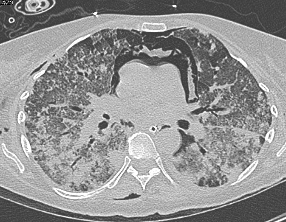 Pneumomediastinum and Extensive Subcutaneous Air in Acute Respiratory Distress Syndrome (ARDS) - CTisus CT Scan