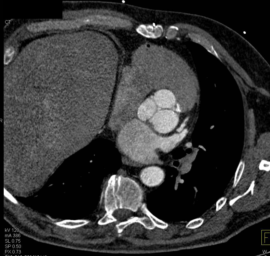 Dilated Aortic Root S/P Repair - CTisus CT Scan