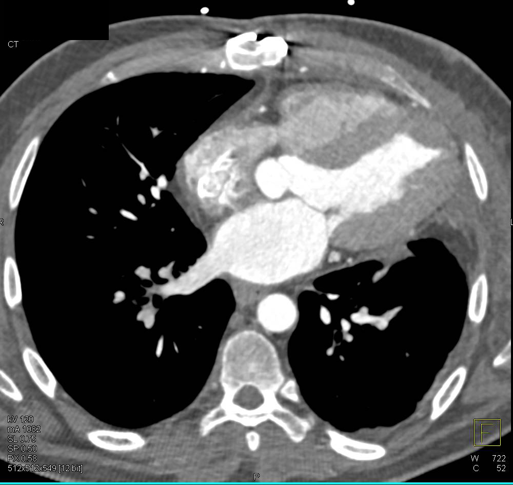 Deformity Left Ventricular Wall due to Prior Infarct - CTisus CT Scan