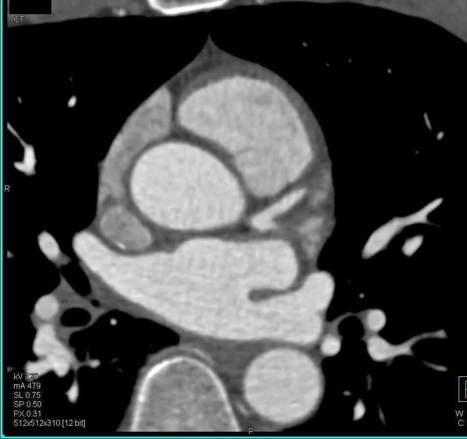 CCTA: High Grade Left Anterior Descending Coronary Artery (LAD) Stenosis in 3D with VRT - CTisus CT Scan