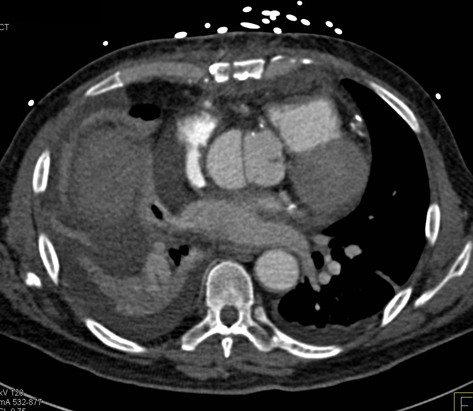 Type A Dissection in Patient with Prior Coronary Artery Bypass Grafts (CABGs) - CTisus CT Scan