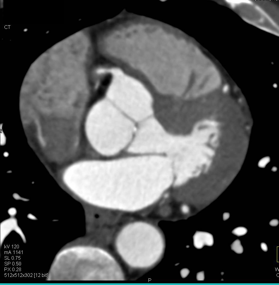 CCTA: Left Anterior Descending Coronary Artery (LAD) Stenosis Approaches 50% with Noncalcified Plaque - CTisus CT Scan