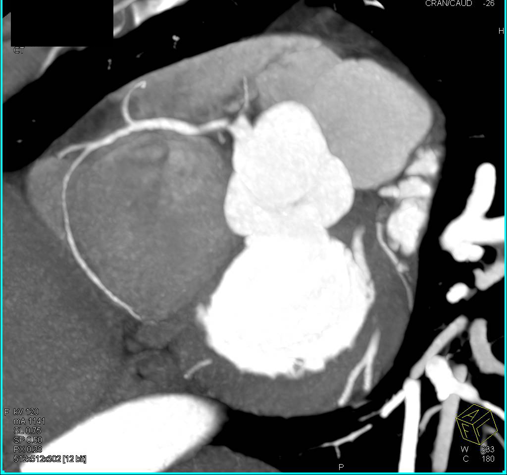 CCTA: Left Anterior Descending Coronary Artery (LAD) Stenosis with Non Calcified Plaque - CTisus CT Scan