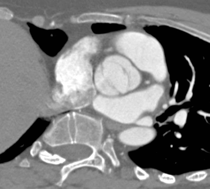 Bicuspid Aortic Valve - CTisus CT Scan