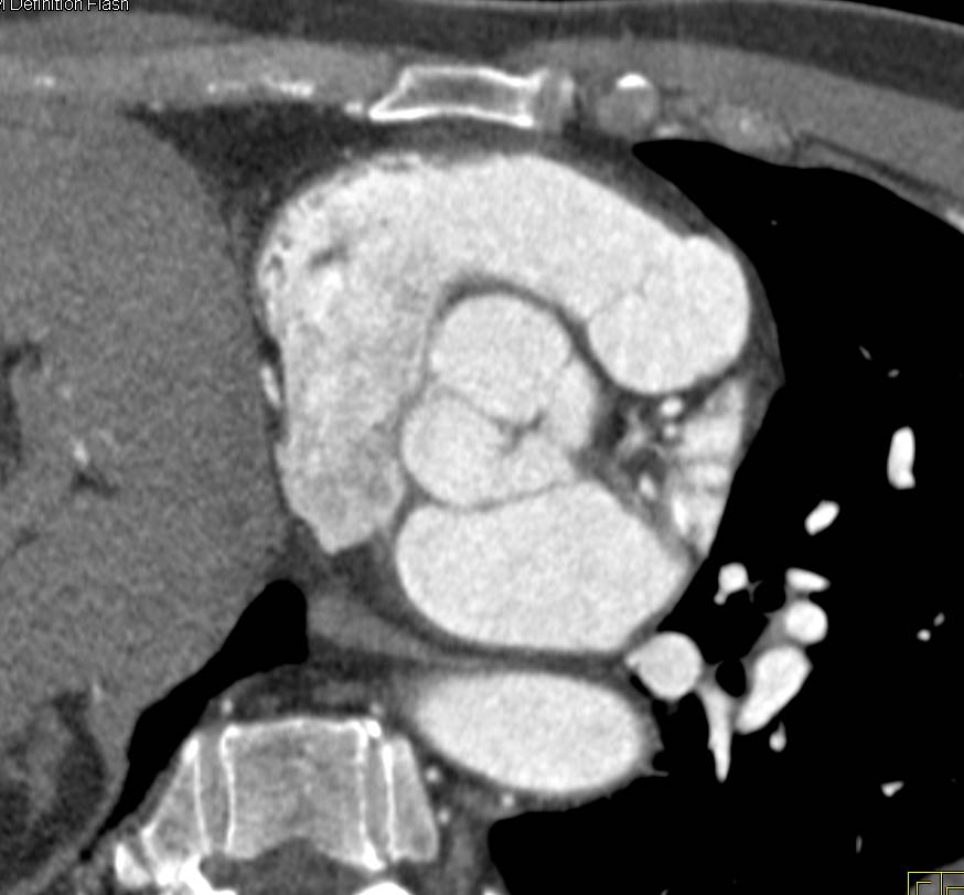 Dilated Aortic Root with Bicuspid Valve - CTisus CT Scan