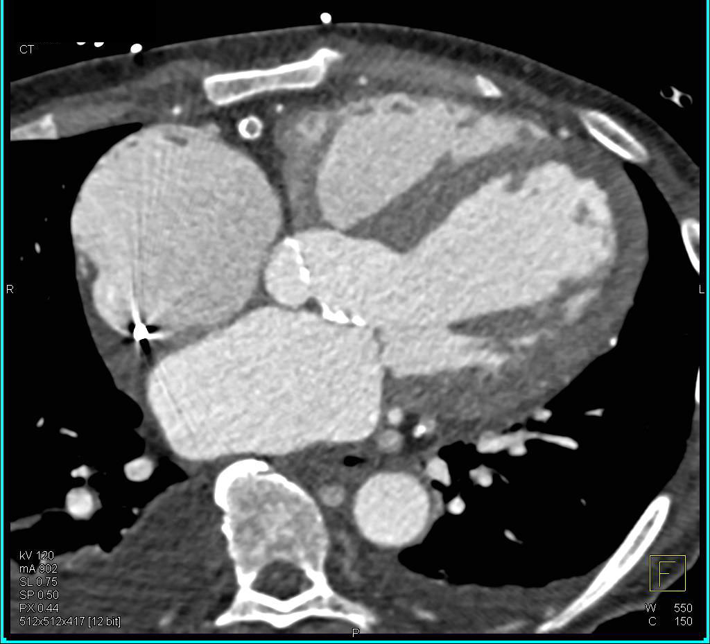 CCTA: Right Coronary Artery Occlusion - CTisus CT Scan