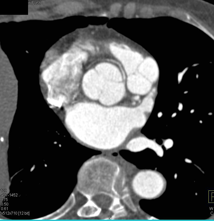 CCTA: Anomalous Origin of Right Coronary Artery (RCA) off Left Cusp in Malignant Configuration - CTisus CT Scan