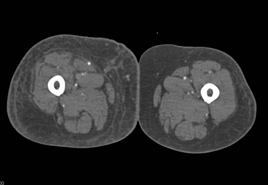 Peripheral Vascular Disease (PVD) with Extensive Left Superficial Femoral Artery (SFA) Popliteal  Artery Vascular Disease - CTisus CT Scan