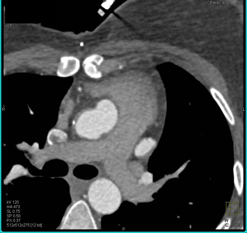 Pseudoaneurysm of the Aortic Root - CTisus CT Scan