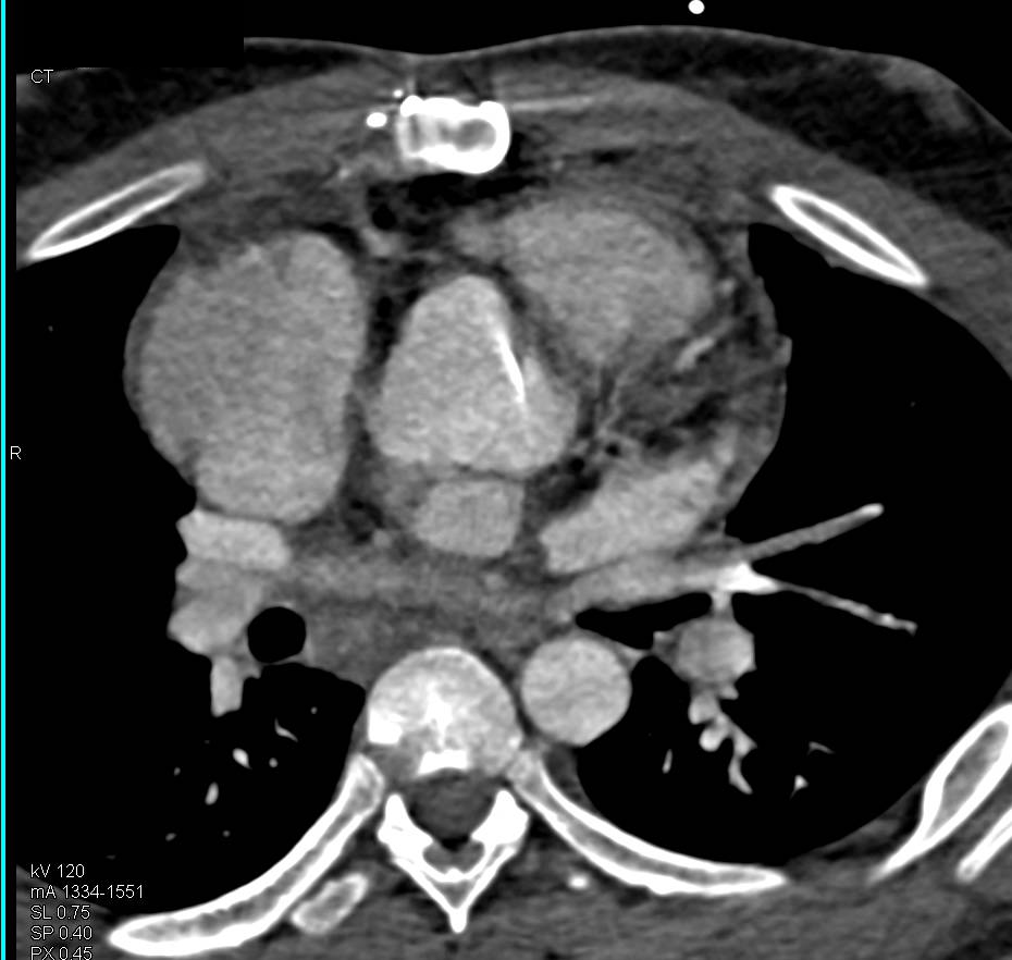 Cardiomegaly with Aortic Valve Replacement (AVR) That is Malfunctioning - CTisus CT Scan