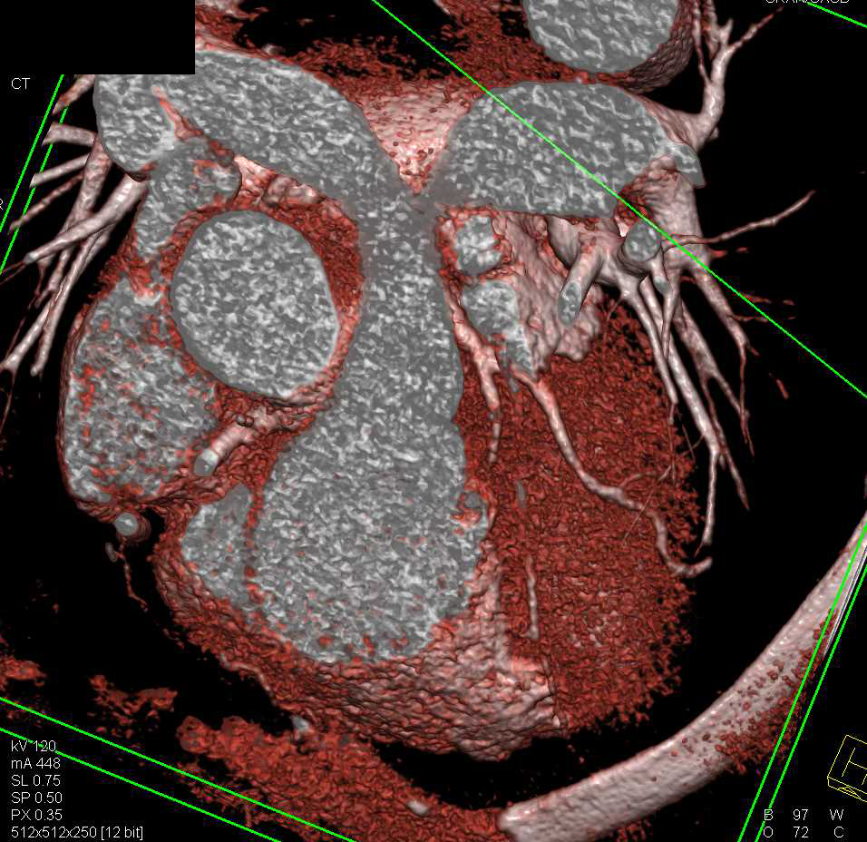 CCTA with Left Anterior Descending Coronary Artery (LAD) Occlusion - CTisus CT Scan