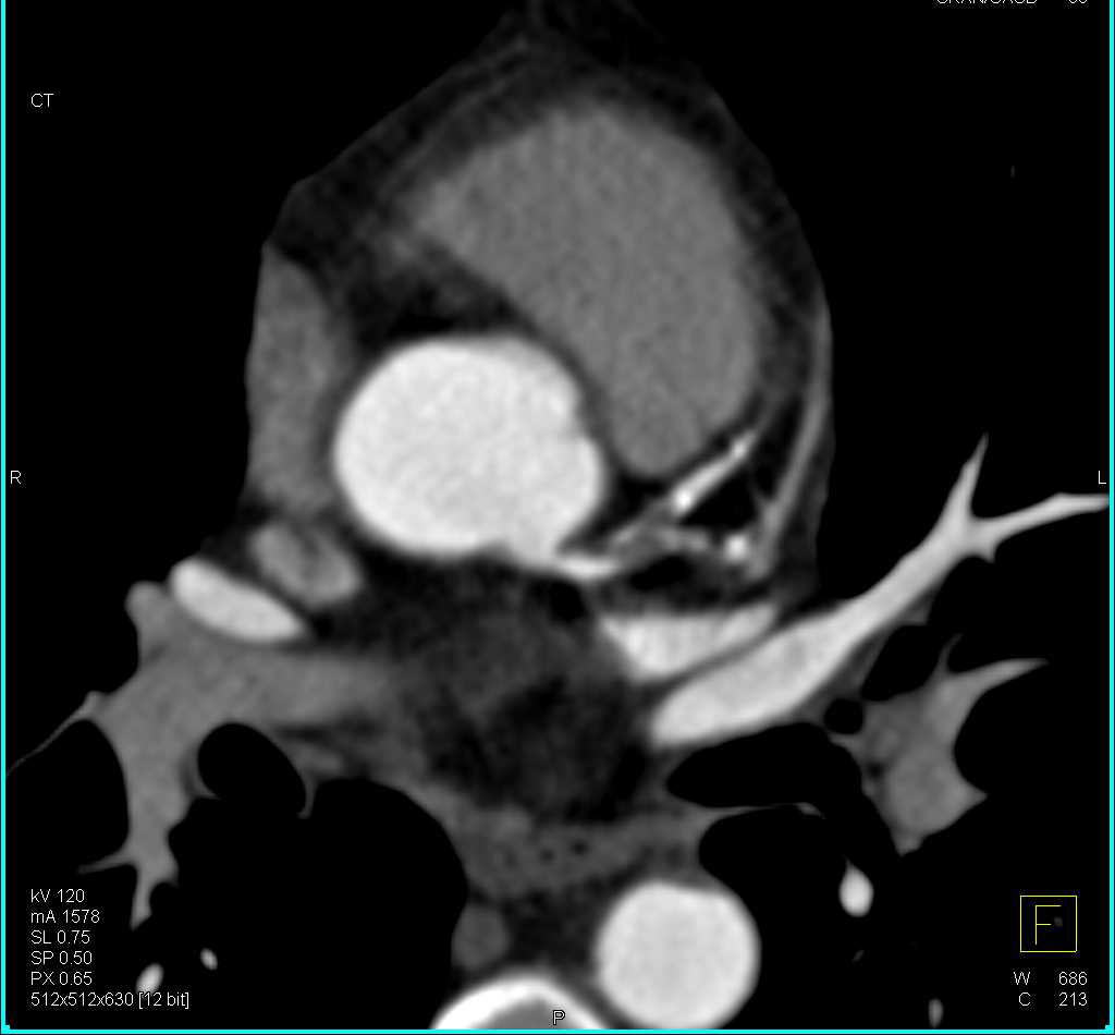 CCTA: Critical Left Anterior Descending Coronary Artery (LAD) Stenosis of Over 80% - CTisus CT Scan