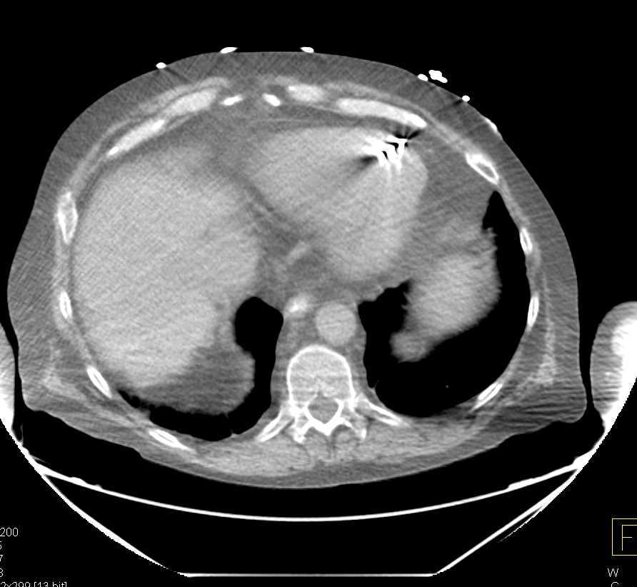Poor Right Sided Heart Function with Dilated Inferior Vena Cava (IVC) and Hepatic Veins - CTisus CT Scan