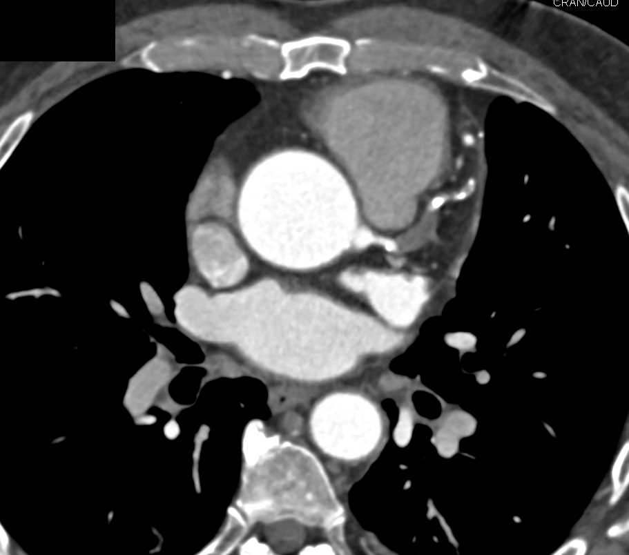 CCTA: Left Anterior Descending Artery (LAD) Occlusion - CTisus CT Scan