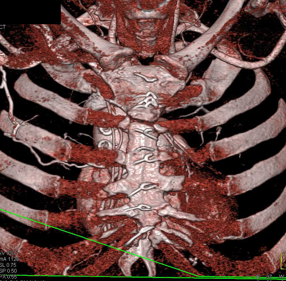 CCTA: Severe Coronary Artery Disease with Quadruple Bypass Grafts - CTisus CT Scan