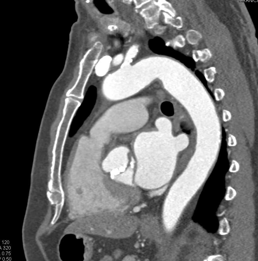 Bicuspid valve with Extensive Calcification and Aortic Stenosis - CTisus CT Scan